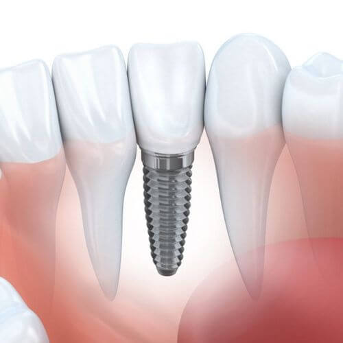 implanturi dentare Cluj